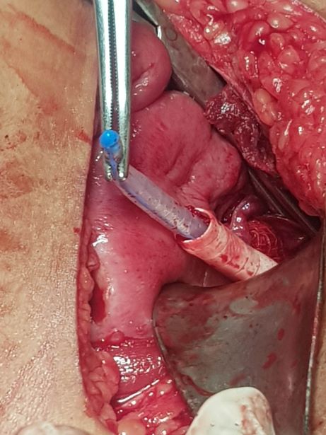 Cervico vaginal reconstruction