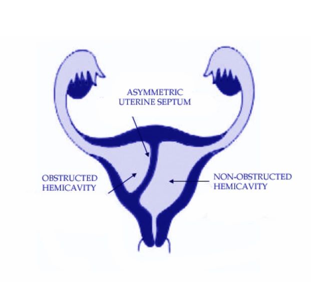 Robert's Uterus